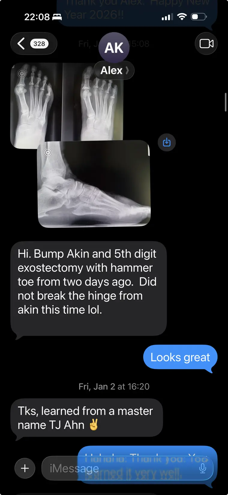 Text from a member sharing a bunion and hammertoe case: learned from a master, TJ Ahn